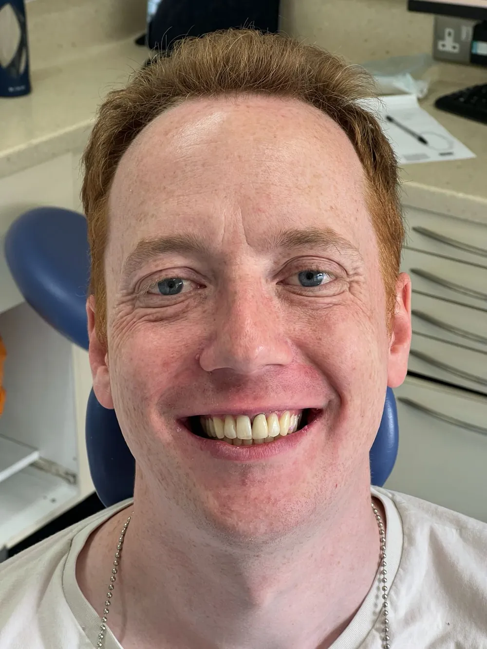 The same patient's smile after Invisalign, with the spacing closed